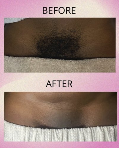 Bikini wax before and after results