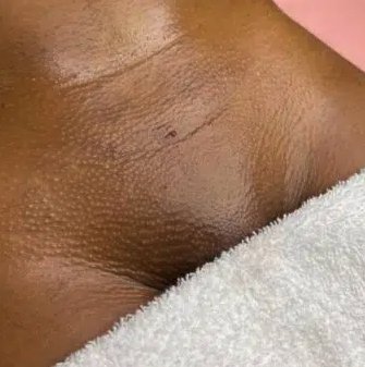 Smooth skin after hair removal
